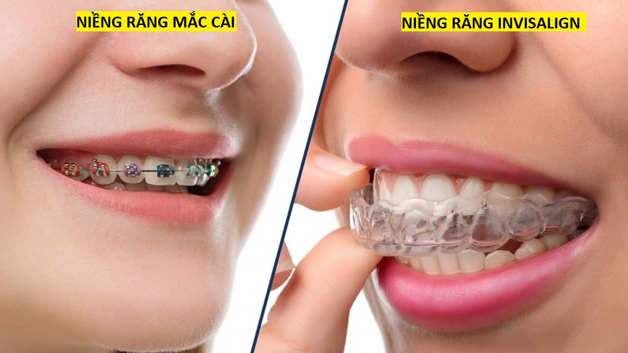 niềng răng Bình Dương